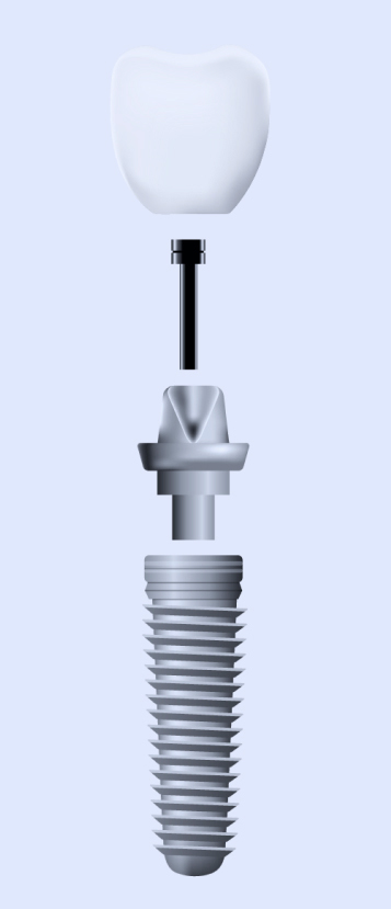 dental implants