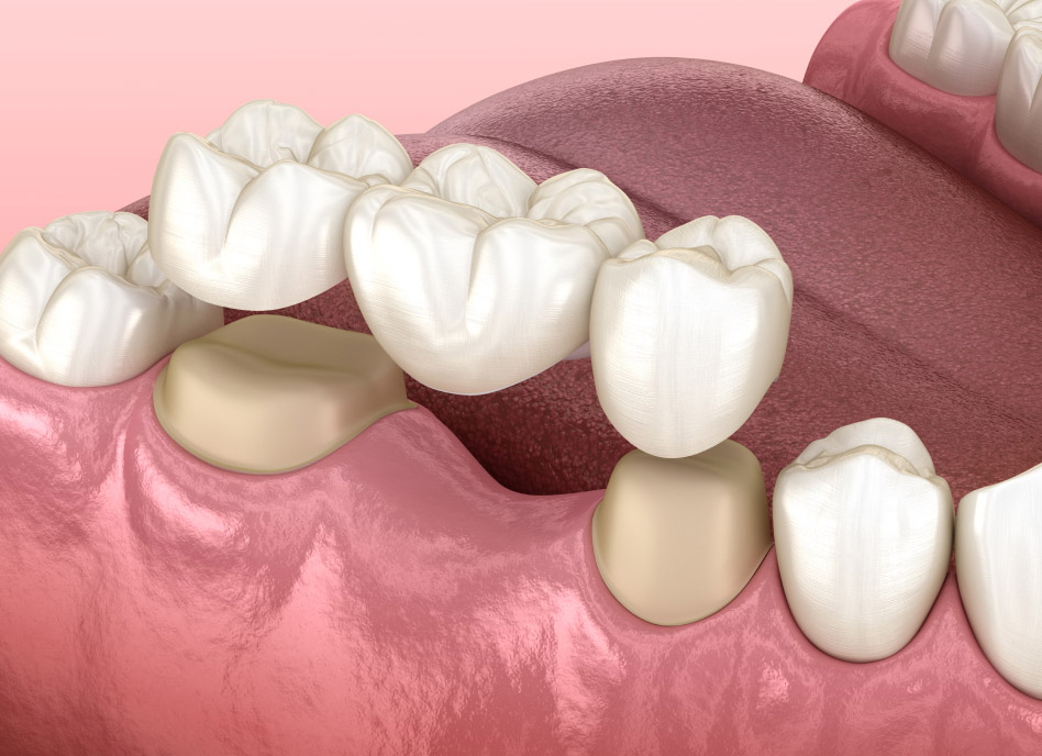 dental bridges