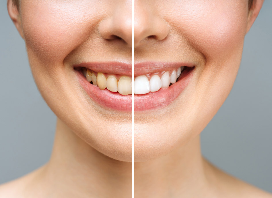 before and after cosmetic dentistry treatments