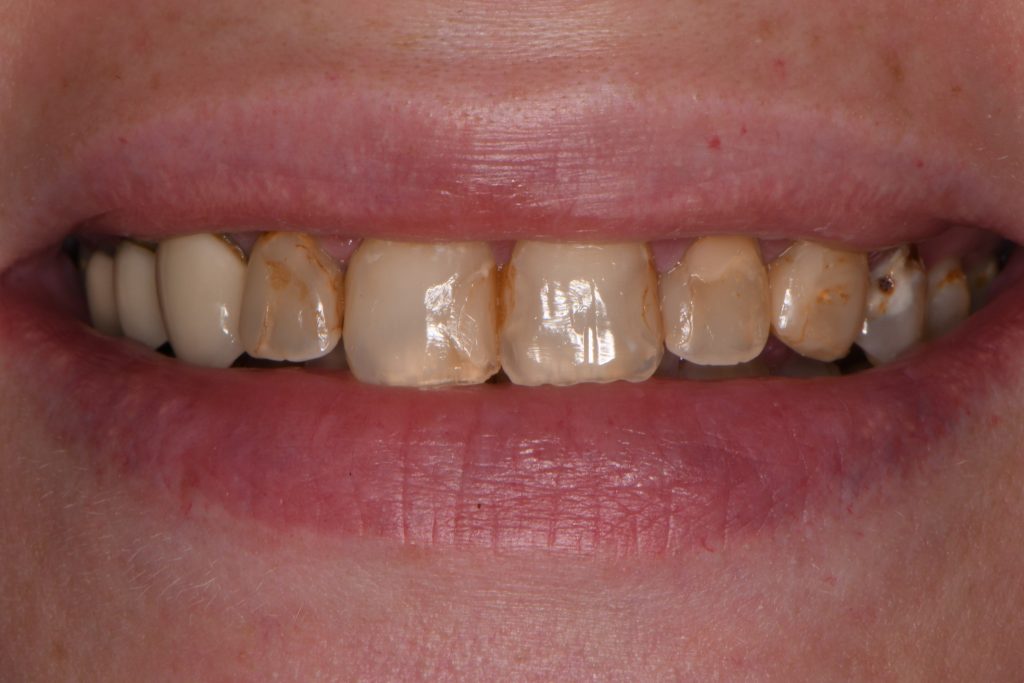 before receiving dental restoration