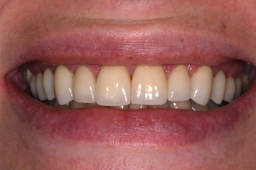after receiving dental restoation