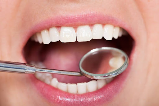 Close-up of a person's open mouth with healthy teeth, dental mirror, and explorer tool, emphasizing dental health and examination related to hereditary dental issues.